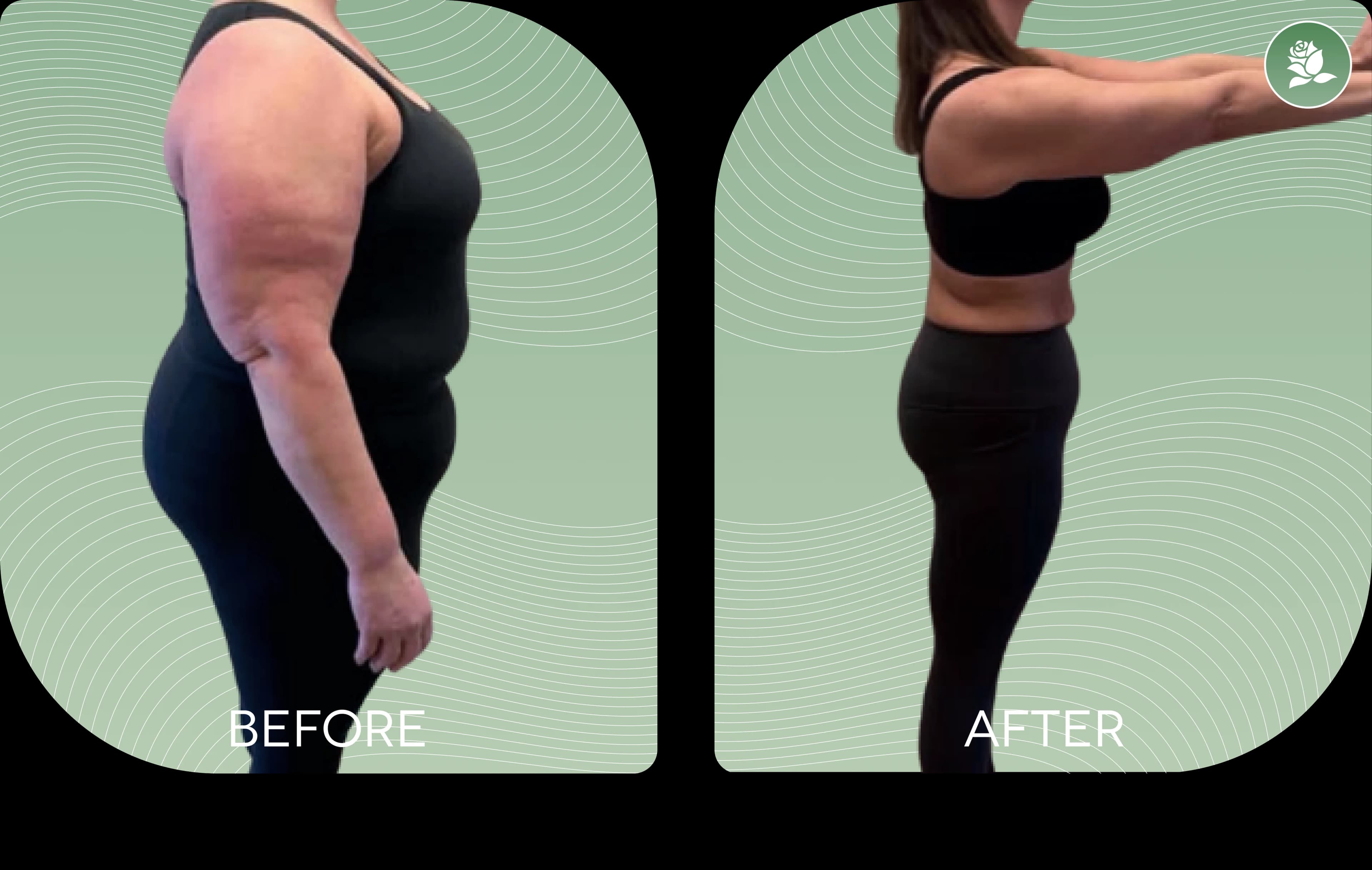 ANNA LINDSTRÖM before and after