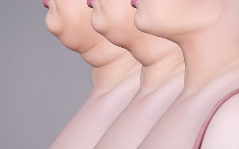 Say Goodbye to Double Chin Woes: Discover the Power of Fat Dissolving Treatments — illustration 1