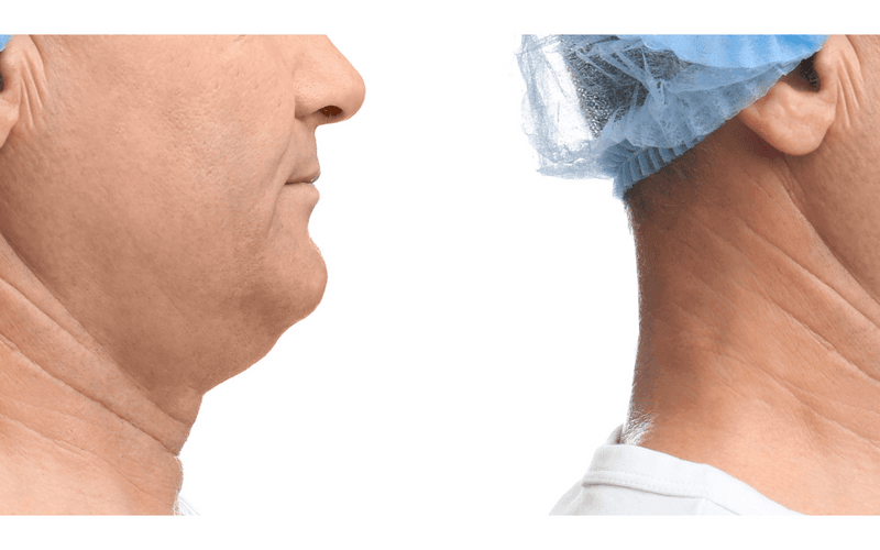 Say Goodbye to Double Chin Woes: Discover the Power of Fat Dissolving Treatments — illustration 2